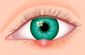 Você sabe o que causa o terçol no olho?
